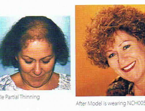 Top Partial Systems – Female Pattern Baldness