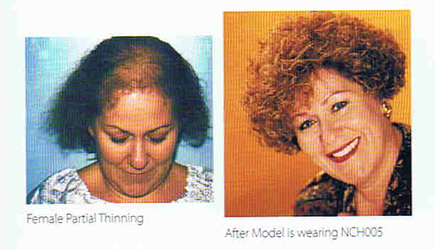 Top Partial Systems – Female Pattern Baldness